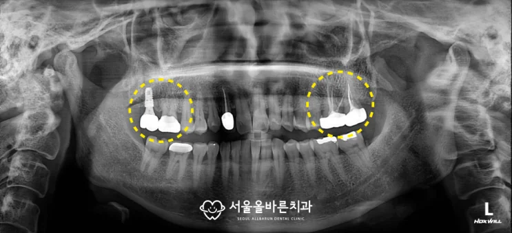 뼈이식 후 어금니 임플란트 완성 주변 교합을 고려했습니다.
