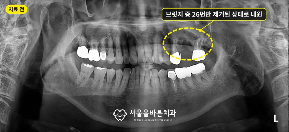 치료 전 파노라마, 브릿지 중 위 왼쪽 첫째 큰어금니만 제거된 상태