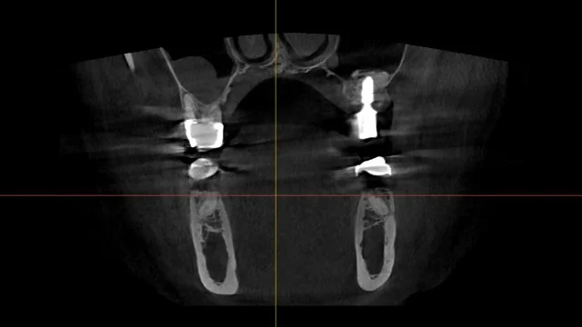 치료 후 CT - 낭종을 제거해 왼쪽 상악동 내부가 비워진 모습