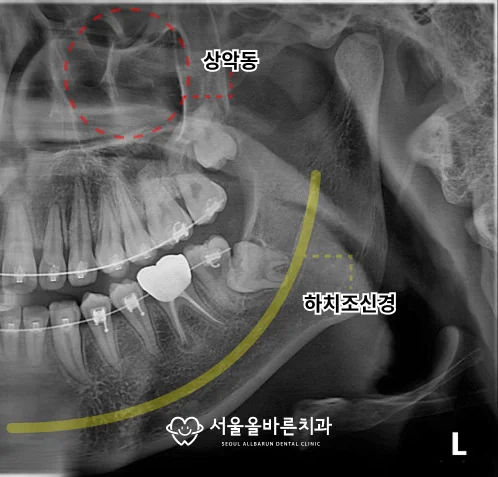 구리 어금니 임플란트, 치과 전문의가 생각하는 중요한 점 - 수술 전 무엇을 확인할까요?