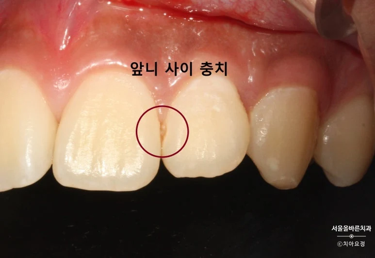 앞니 사이 충치, 레진 치료 전