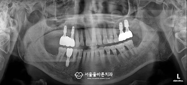 골유착 확인 엑스레이 — 상악 좌측 골이식 부위 치조골 형성 상태