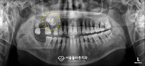 파노라마 엑스레이 — 매복치·치아종 위치 표시