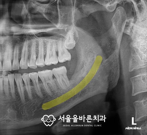 발치 7개월 후 확대 사진, 하치조신경관