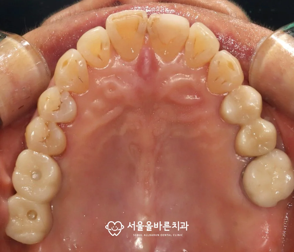 보철 완료 후 위턱 구강 사진