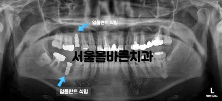 구리 어금니 임플란트, 염증 때문에 까다로운 케이스 - 치료 과정