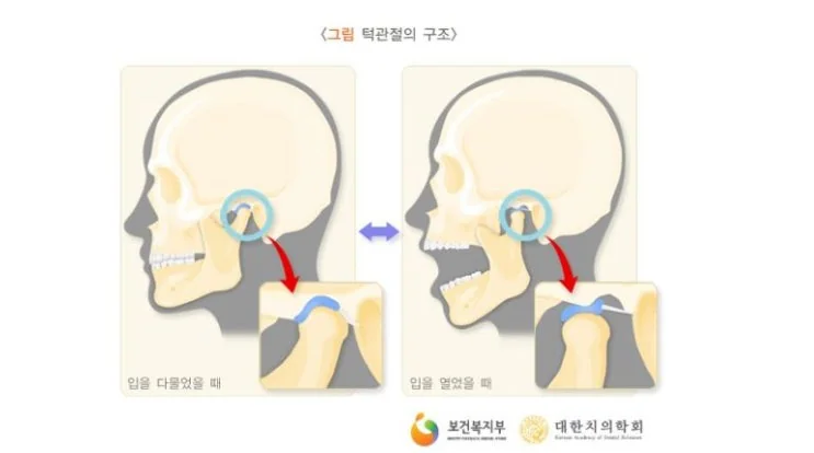 구리 수택동 턱관절 염증, 어떤 증상이 있을까요? - 턱에서 나는 소리