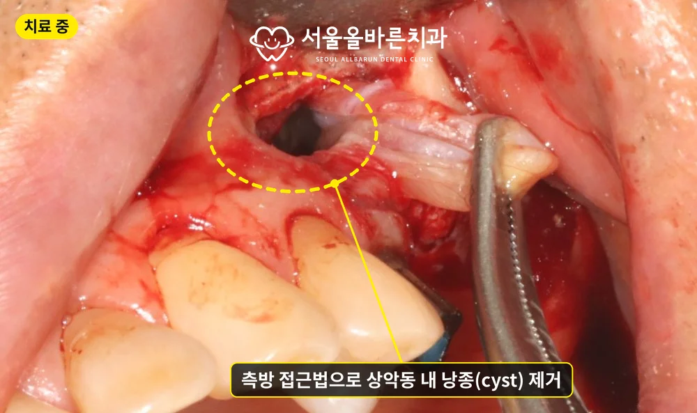 측방 접근법으로 상악동 안의 낭종을 제거하는 모습