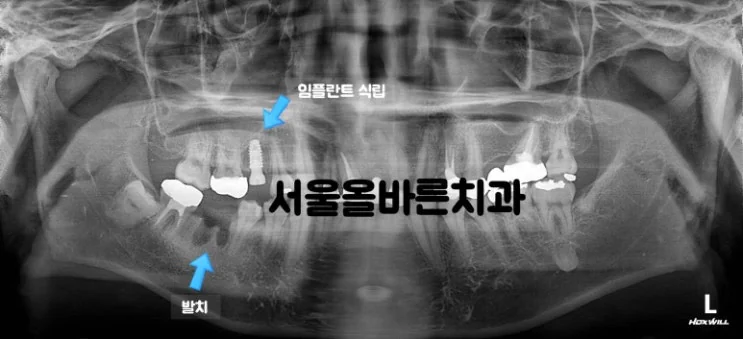 구리 어금니 임플란트, 염증 때문에 까다로운 케이스 - 치료 과정