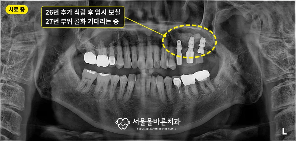 26번 추가 식립 후 임시 보철을 사용하며 27번 부위 골화를 기다리는 파노라마