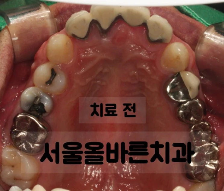 구리 어금니 임플란트, 염증 때문에 까다로운 케이스 - 치료 결과