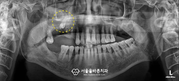 제거한 매복치·치아종