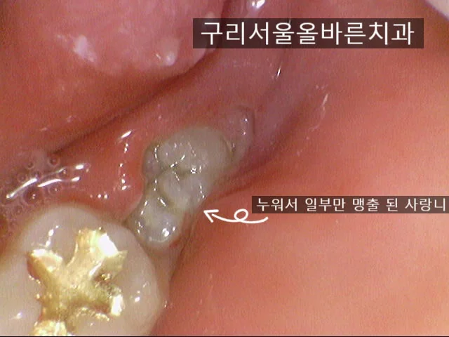 구리 매복 사랑니 발치는 어떻게 수술을 하나요? (구강악안면외과 전문의 진료 후기) - 초기 진단