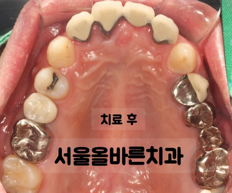 구리 어금니 임플란트, 염증 때문에 까다로운 케이스 - 치료 결과
