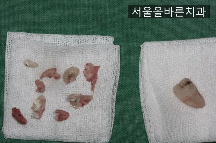 구리 매복 사랑니 발치는 어떻게 수술을 하나요? (구강악안면외과 전문의 진료 후기) - 치료 과정