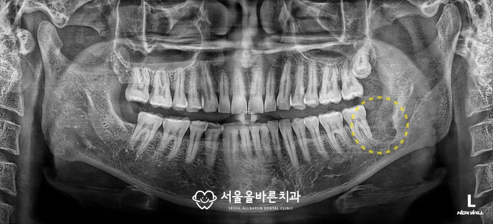 2018년 7월, 잔존 사랑니 제거 직후 파노라마 엑스레이