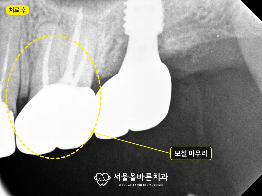 2026년 1월 보철 마무리 후 엑스레이