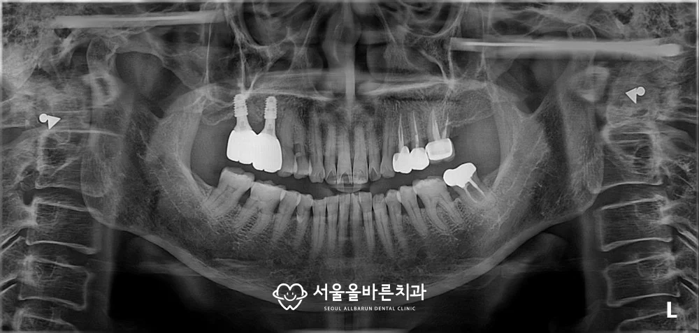 2026년 3월 검진 파노라마 엑스레이